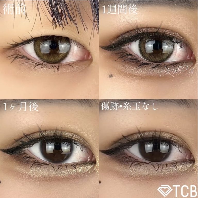 二重埋没法(担当医:TCB 医師)の症例写真1