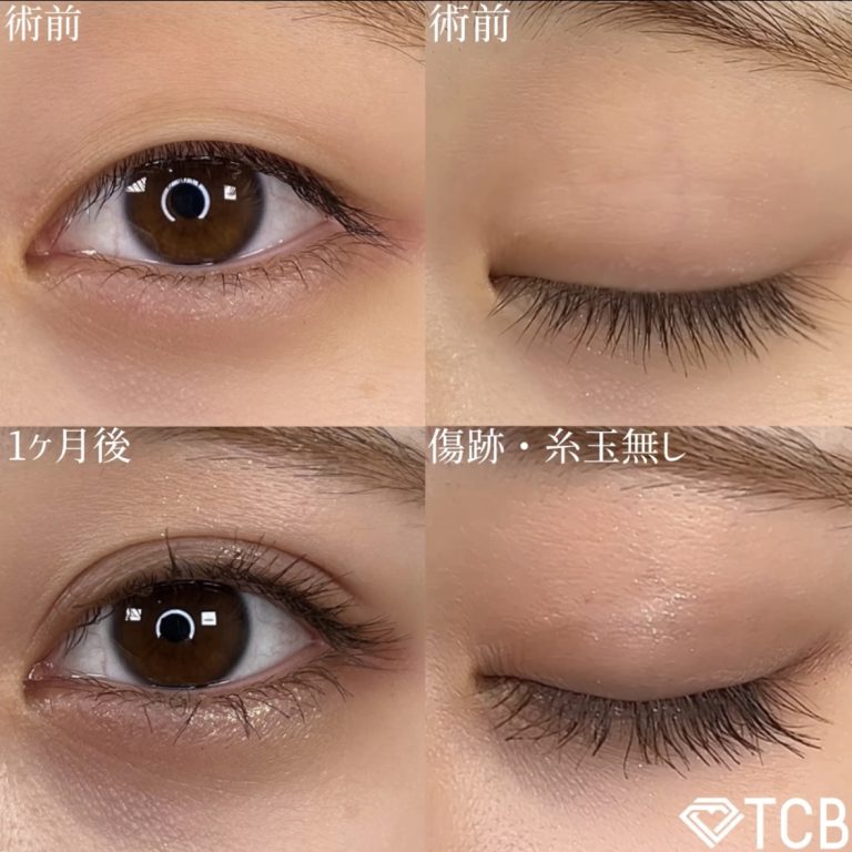 二重埋没法(担当医:TCB 医師)の症例写真1