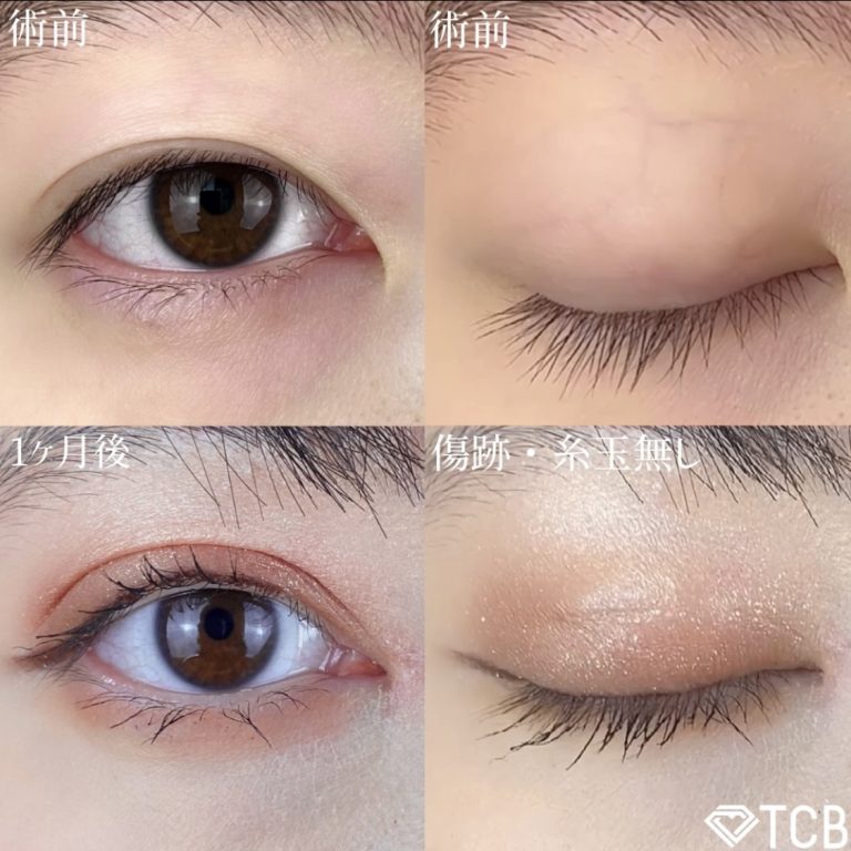 二重埋没法(担当医:TCB 医師)の症例写真1
