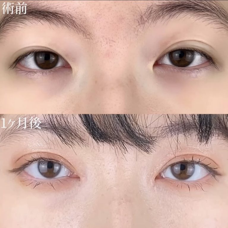 二重埋没法(担当医:TCB 医師)の症例写真2