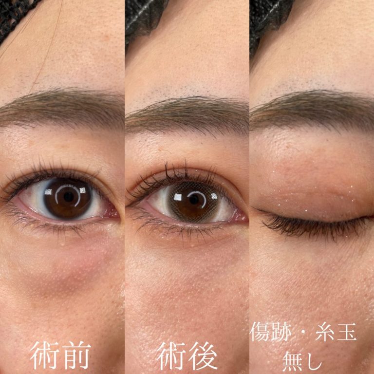 二重埋没法(担当医:原 直紀 医師)の症例写真2