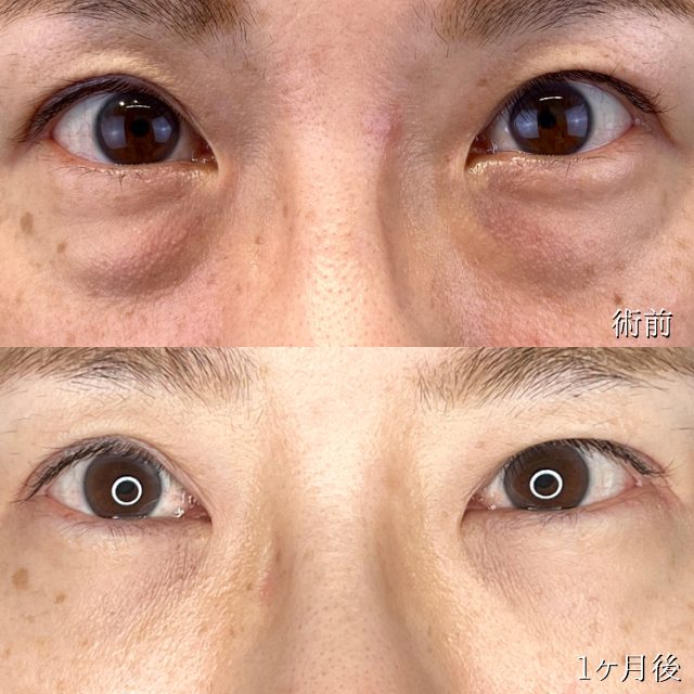 切らない目の下のクマ取り・目の下のたるみ（ふくらみ）取り(担当医:TCB 医師)の症例写真1