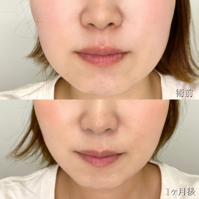 小顔美肌再生（リフトアップ）(担当医:TCB 医師)の症例写真1