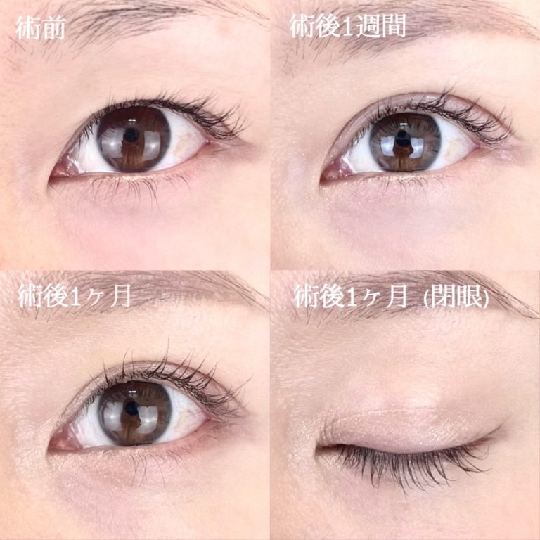二重埋没法(担当医:TCB 医師)の症例写真1