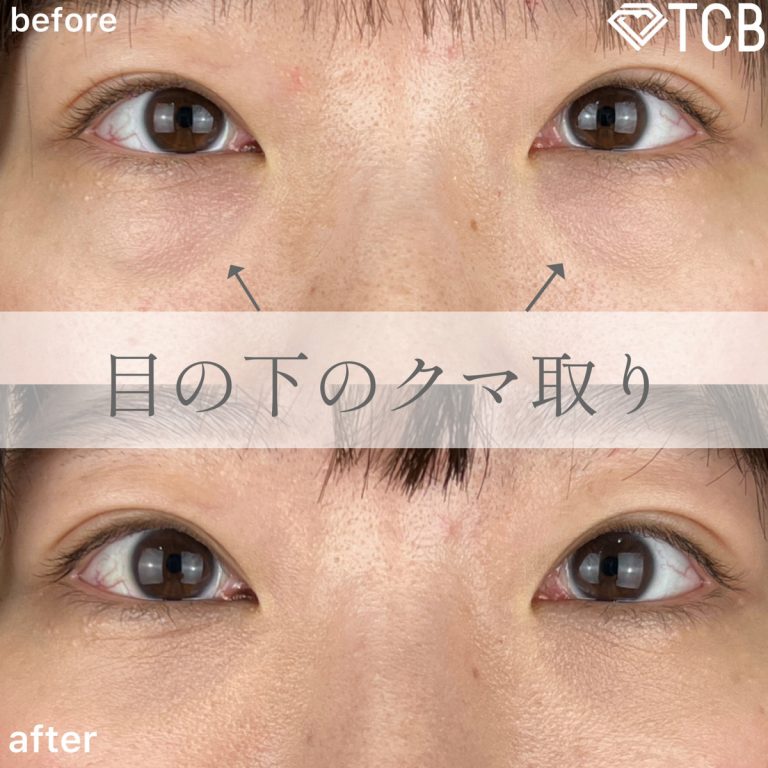 切らない目の下のクマ取り・目の下のたるみ（ふくらみ）取り(担当医:TCB 医師)の症例写真1
