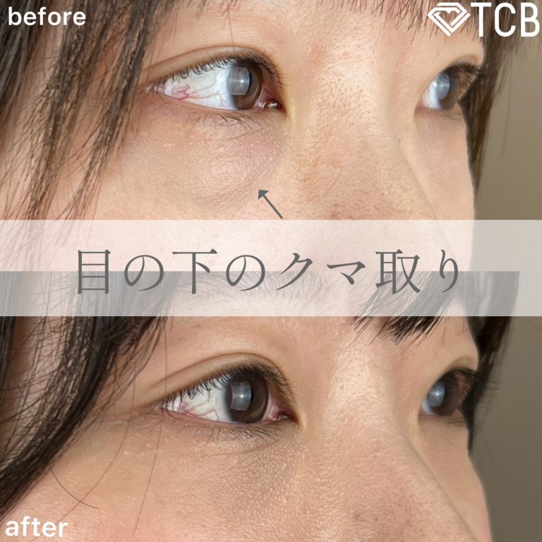 切らない目の下のクマ取り・目の下のたるみ（ふくらみ）取り(担当医:TCB 医師)の症例写真2