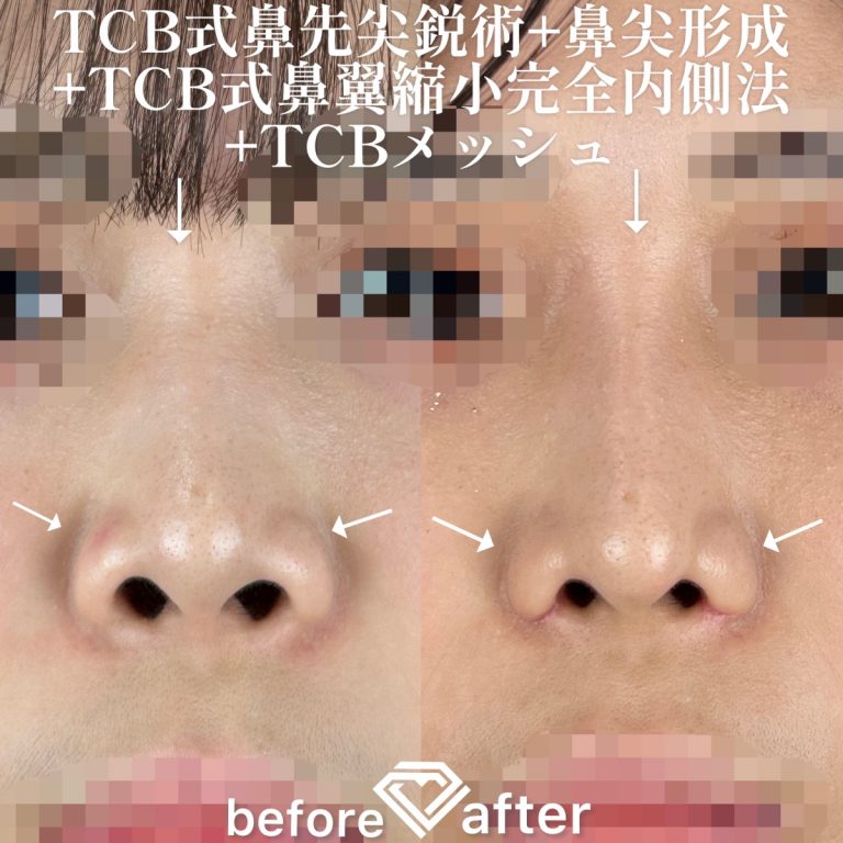 鼻尖形成(担当医:TCB 医師)の症例写真1