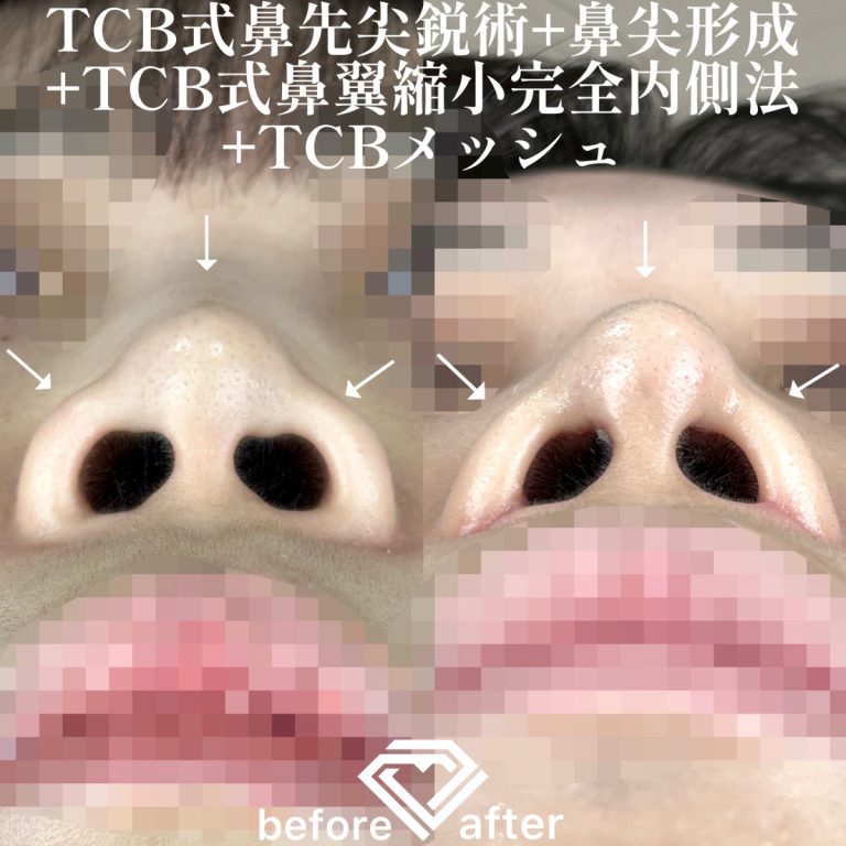 TCB式鼻先尖鋭術（だんご鼻解消）(担当医:TCB 医師)の症例写真4