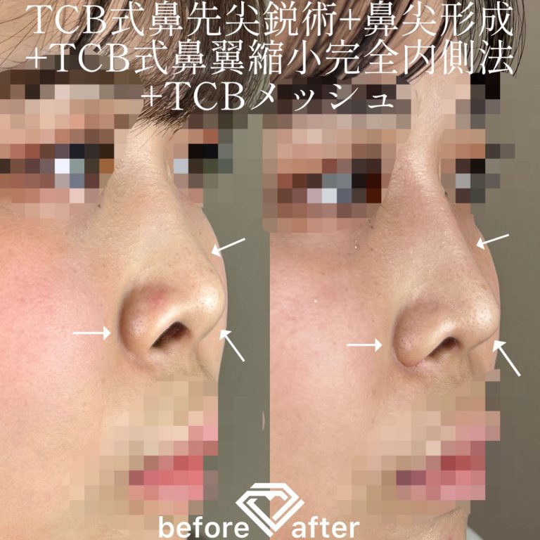 鼻尖形成(担当医:TCB 医師)の症例写真2