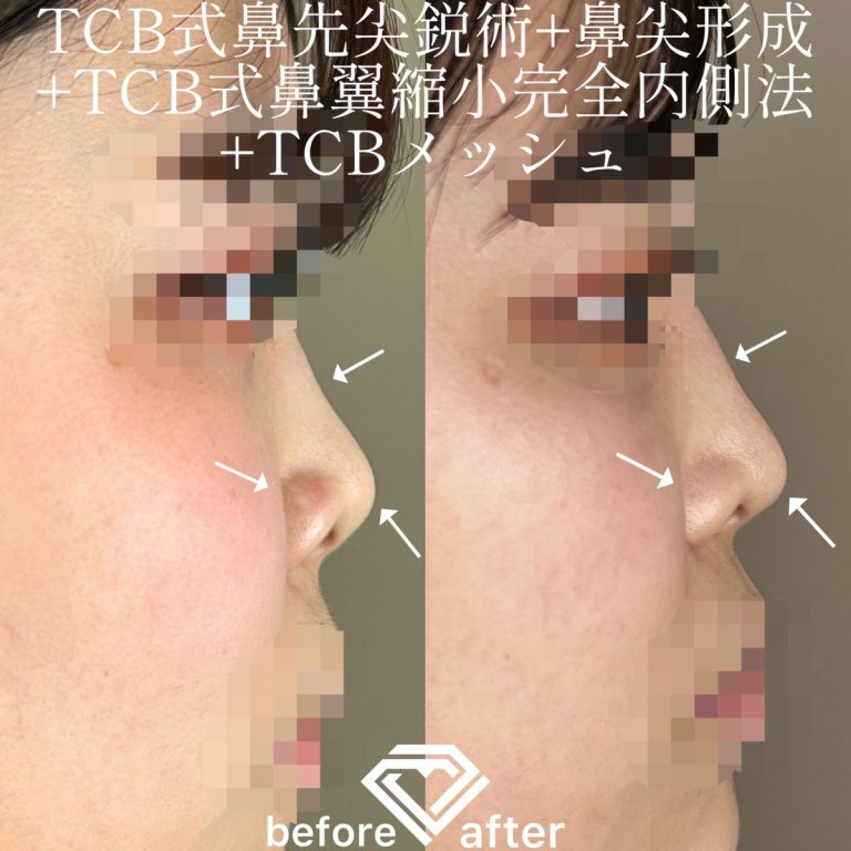 鼻尖形成(担当医:TCB 医師)の症例写真3