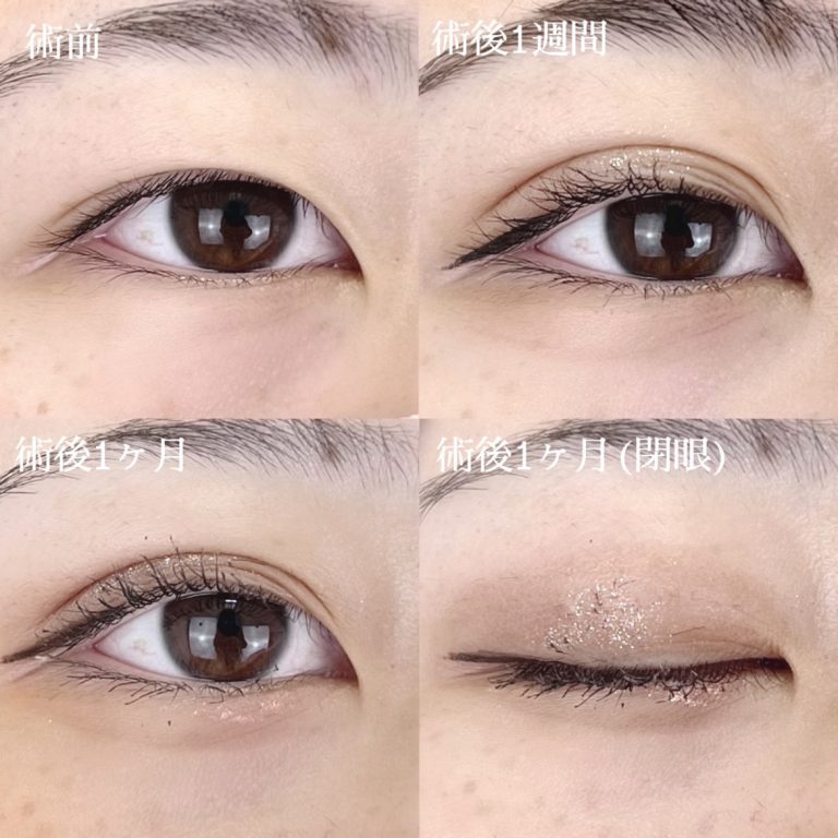 二重埋没法(担当医:TCB 医師)の症例写真1