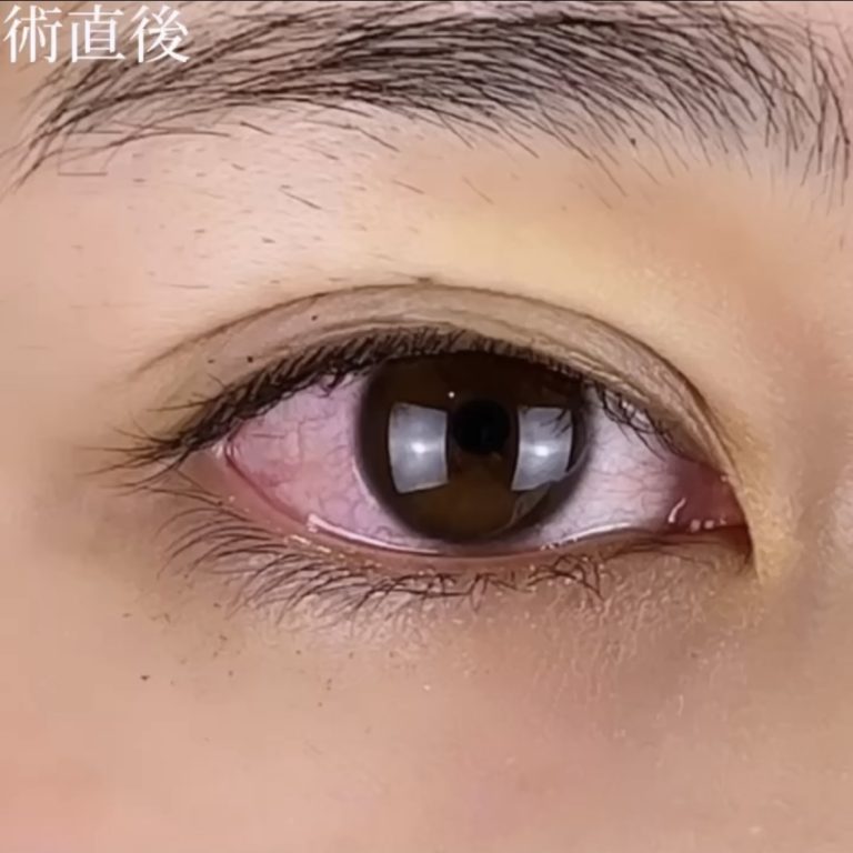 二重埋没法(担当医:TCB 医師)の症例写真3
