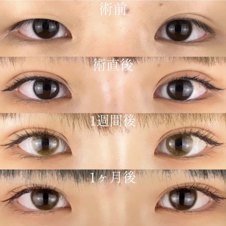二重埋没法(担当医:TCB 医師)の症例写真3