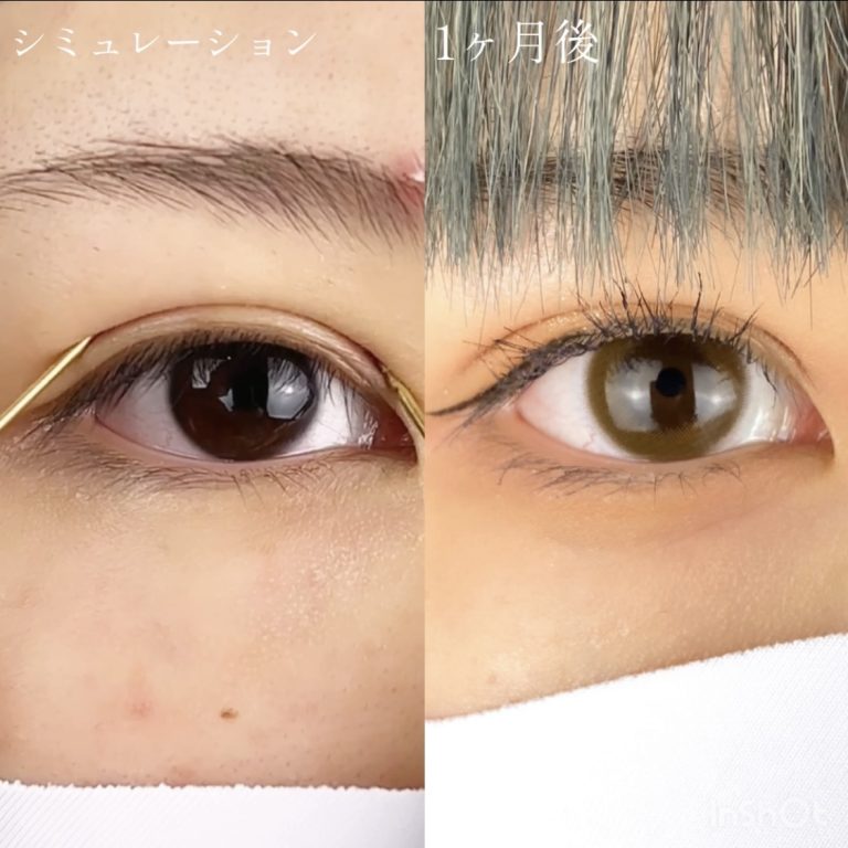 二重埋没法(担当医:TCB 医師)の症例写真2