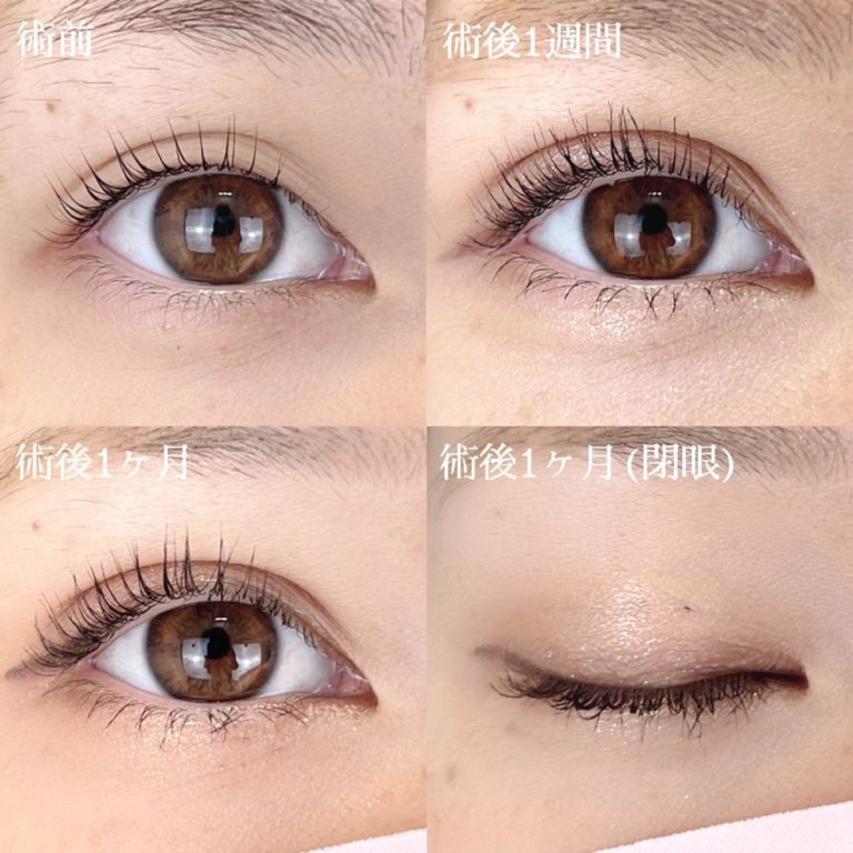 二重埋没法(担当医:TCB 医師)の症例写真1
