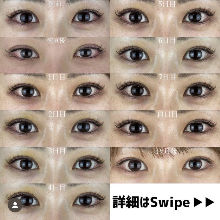 二重埋没法(担当医:TCB 医師)の症例写真1