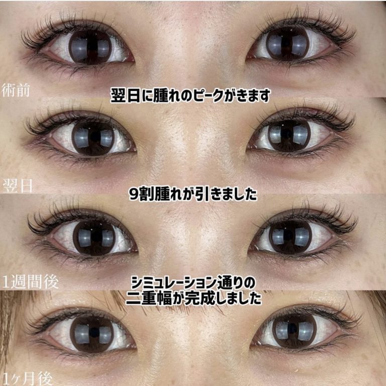 二重埋没法(担当医:TCB 医師)の症例写真2