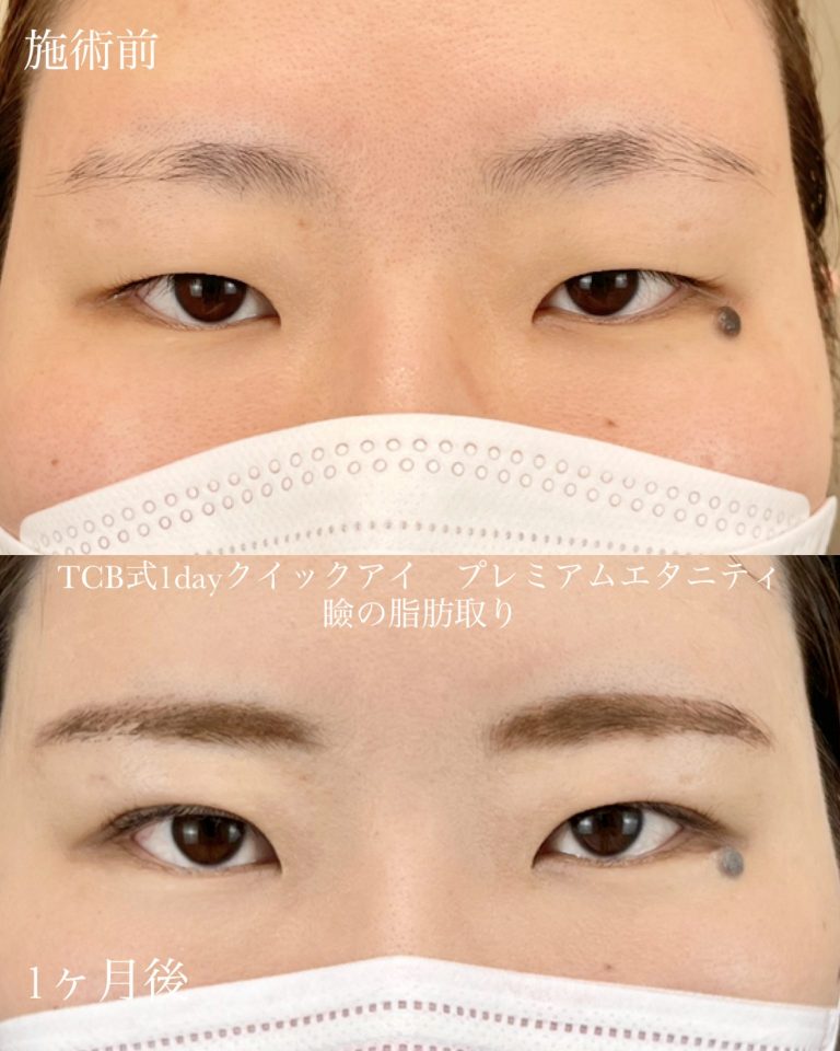 二重埋没法(担当医:TCB 医師)の症例写真1