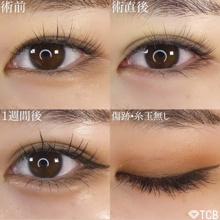 二重埋没法(担当医:TCB 医師)の症例写真1