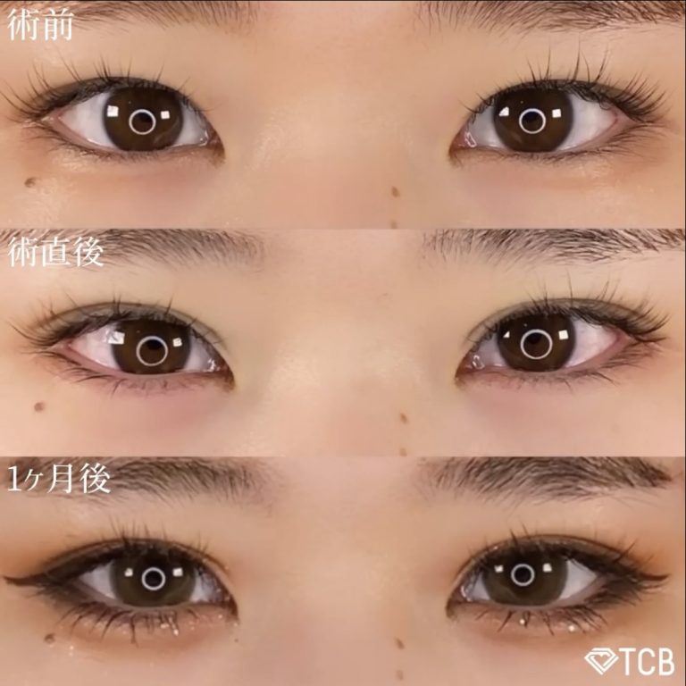 二重埋没法(担当医:TCB 医師)の症例写真2