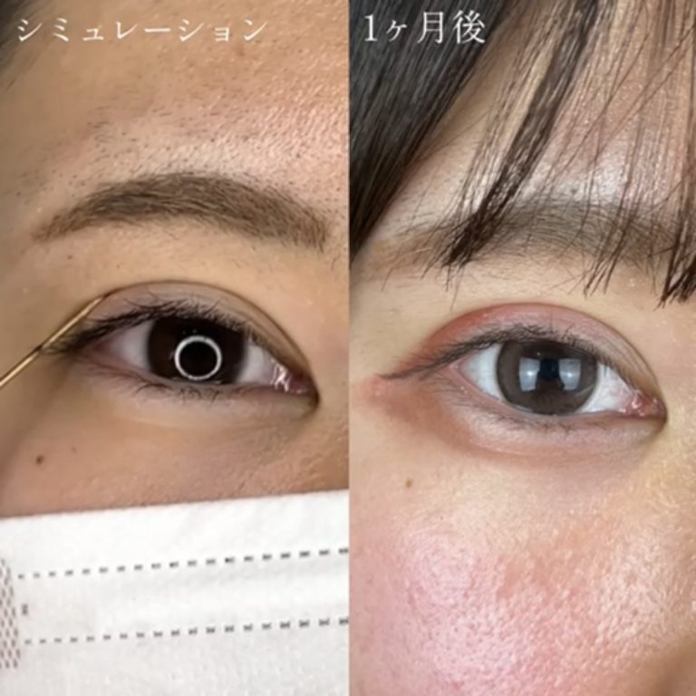 二重埋没法(担当医:TCB 医師)の症例写真2