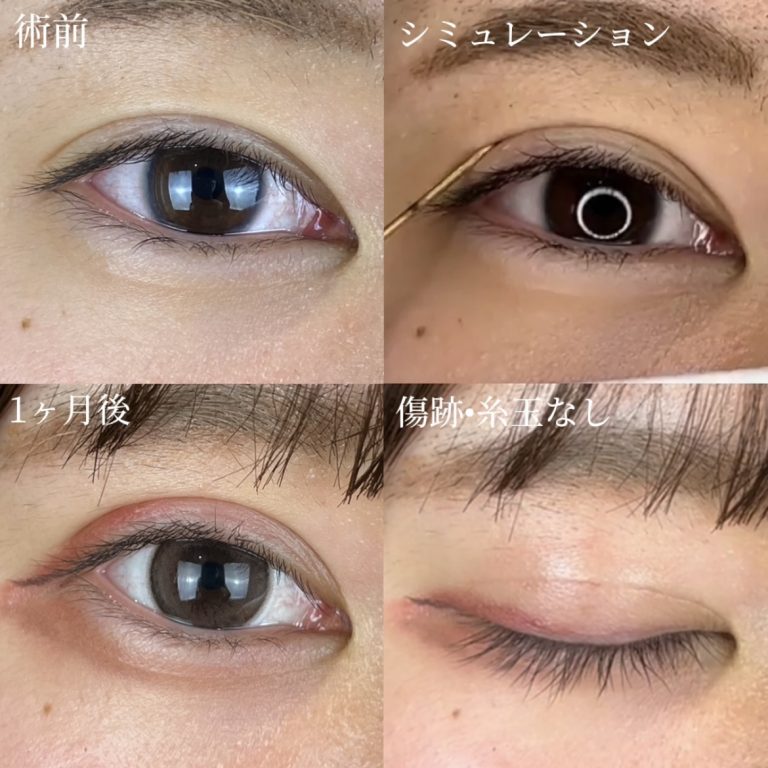 二重埋没法(担当医:TCB 医師)の症例写真1