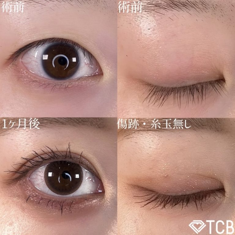 二重埋没法(担当医:TCB 医師)の症例写真1