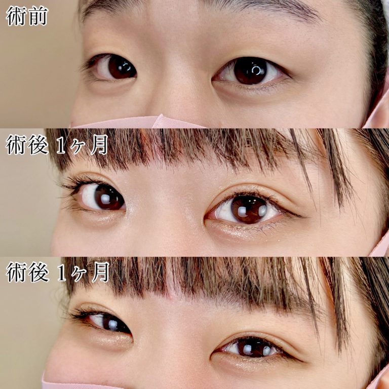 二重埋没法(担当医:TCB 医師)の症例写真2