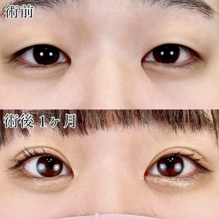 二重埋没法(担当医:TCB 医師)の症例写真1