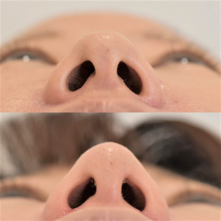TCB式鼻先尖鋭術（だんご鼻解消）(担当医:村田 将光 医師)の症例写真1