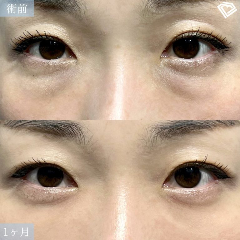 切らない目の下のクマ取り・目の下のたるみ（ふくらみ）取り(担当医:TCB 医師)の症例写真1