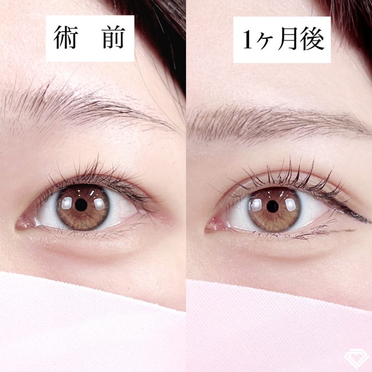 二重埋没法(担当医:TCB 医師)の症例写真1