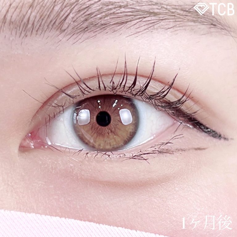 二重埋没法(担当医:TCB 医師)の症例写真2