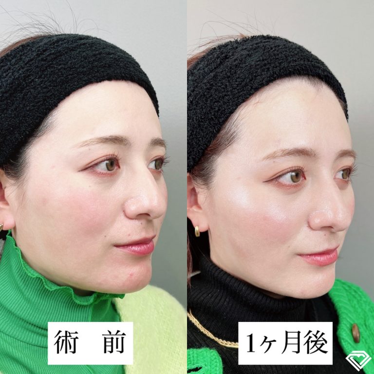 小顔美肌再生（リフトアップ）(担当医:TCB 医師)の症例写真2