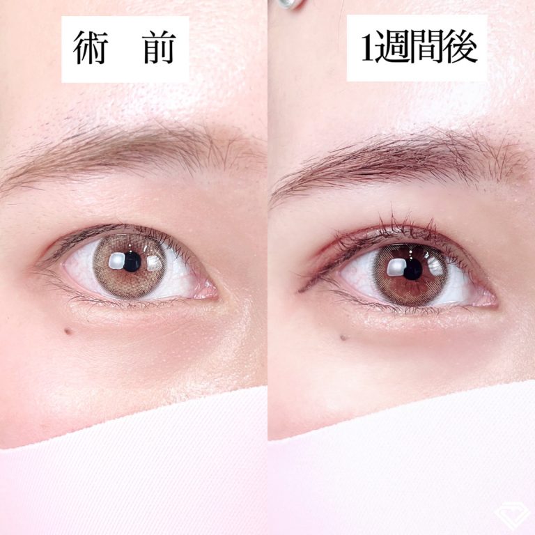 二重埋没法(担当医:TCB 医師)の症例写真1