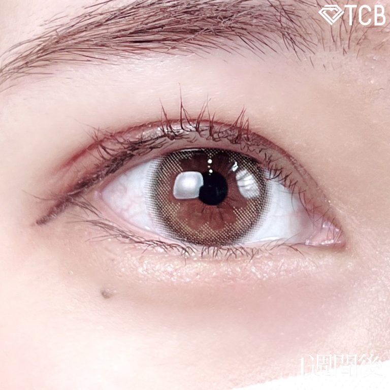 二重埋没法(担当医:TCB 医師)の症例写真2