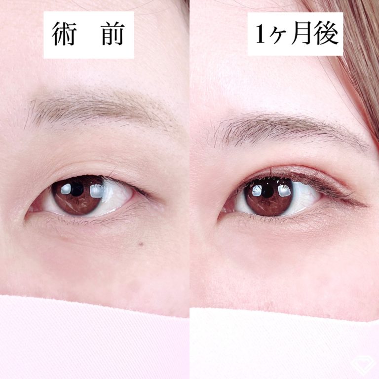 二重埋没法(担当医:TCB 医師)の症例写真1
