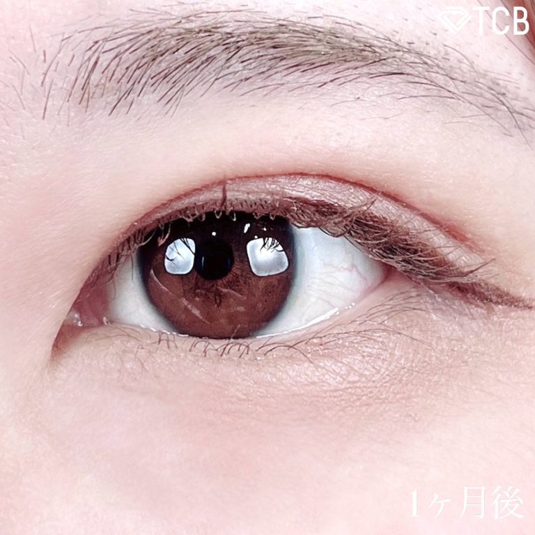 二重埋没法(担当医:TCB 医師)の症例写真2