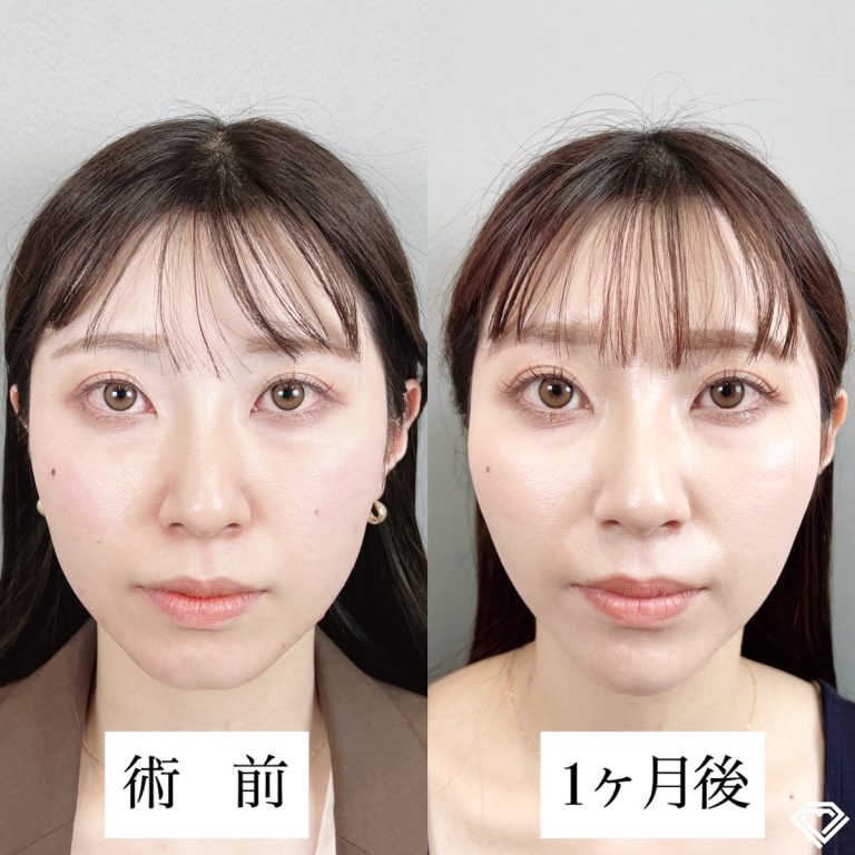 小顔美肌再生（リフトアップ）(担当医:TCB 医師)の症例写真1