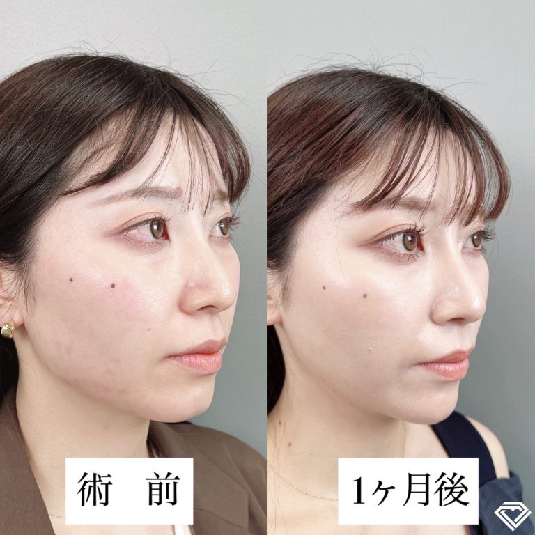 小顔美肌再生（リフトアップ）(担当医:TCB 医師)の症例写真2