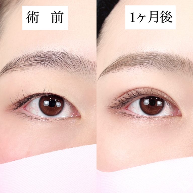 二重埋没法(担当医:TCB 医師)の症例写真1