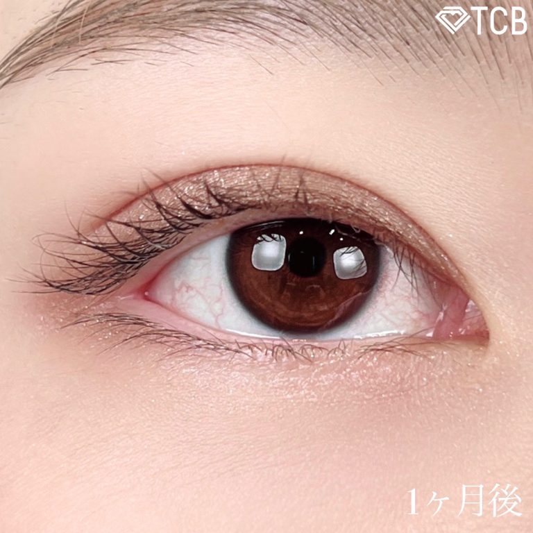 二重埋没法(担当医:TCB 医師)の症例写真2