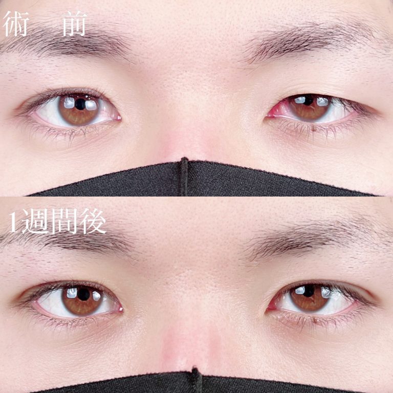 二重埋没法(担当医:TCB 医師)の症例写真1