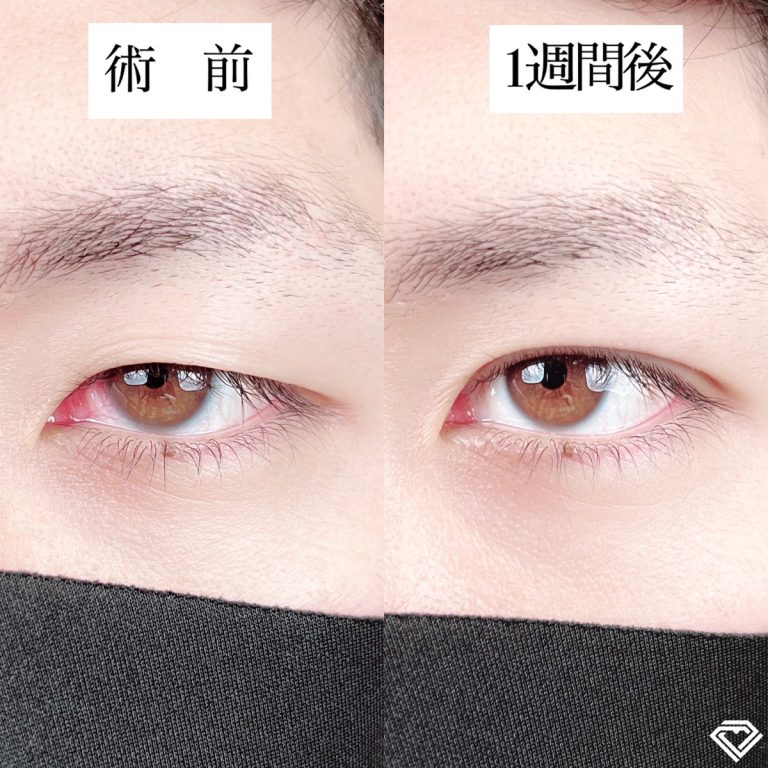二重埋没法(担当医:TCB 医師)の症例写真2