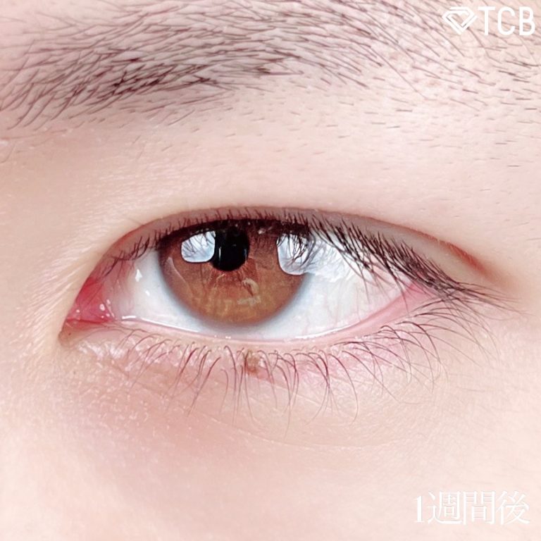 二重埋没法(担当医:TCB 医師)の症例写真3
