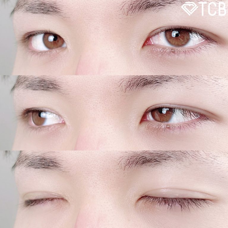 二重埋没法(担当医:TCB 医師)の症例写真4