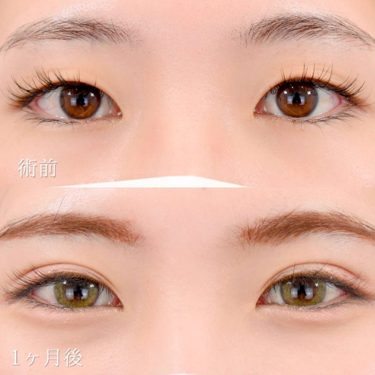 二重埋没法(担当医:TCB 医師)の症例写真1