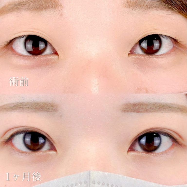 二重埋没法(担当医:TCB 医師)の症例写真1