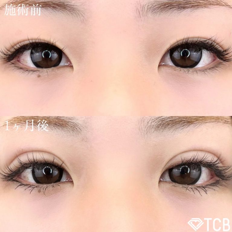 二重埋没法(担当医:TCB 医師)の症例写真1