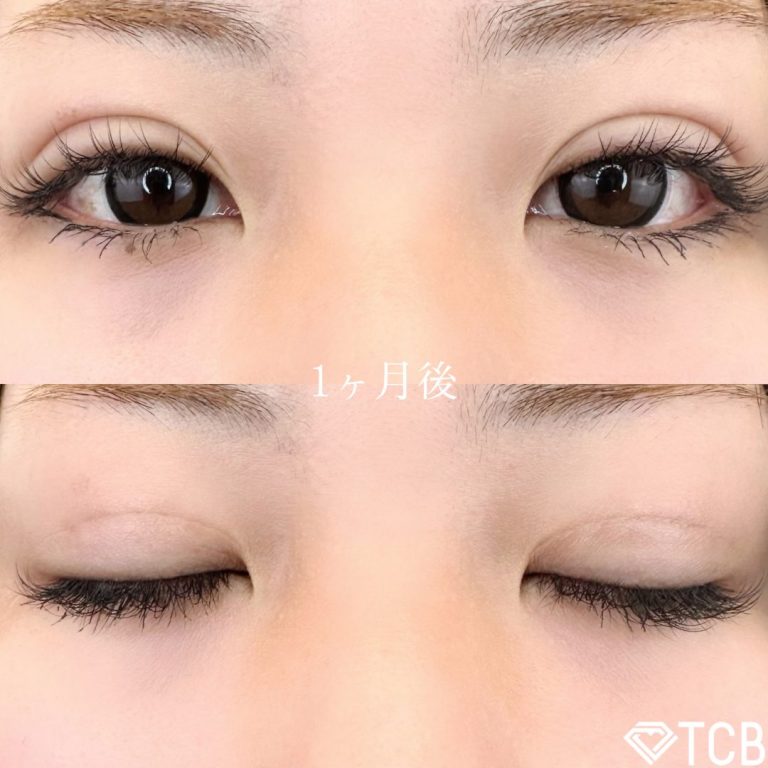 二重埋没法(担当医:TCB 医師)の症例写真2